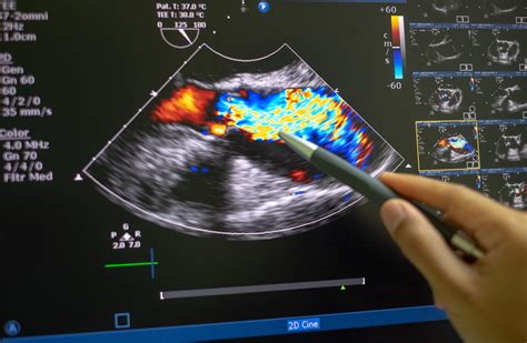 Ultrasound image of the heart