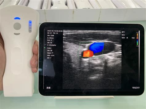 Ultrasound image of the gallbladder