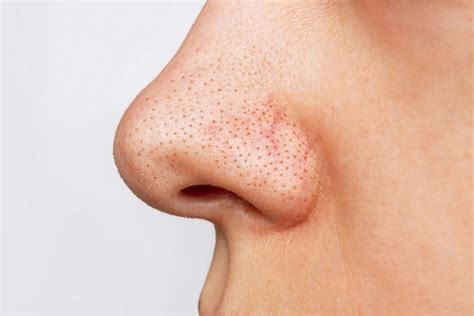 Understanding Blackheads