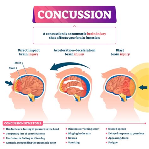 Understanding Concussions