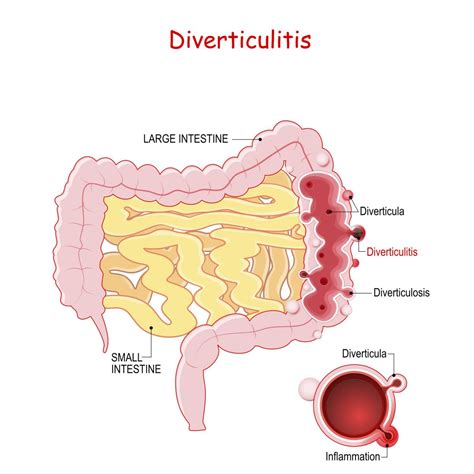 Understanding Diverticulitis