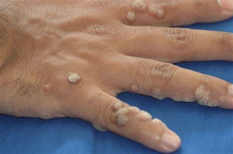 Understanding Hand Warts