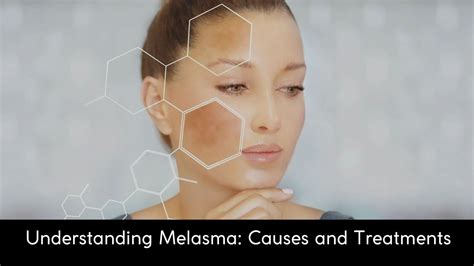 Understanding Melasma