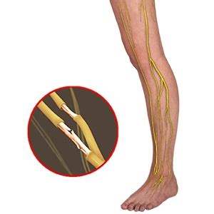 Understanding Nerve Damage