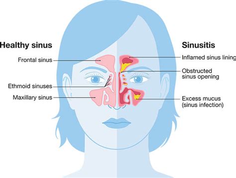 Understanding Sinusitis