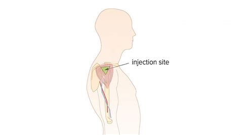 Upper Arm Injection Site