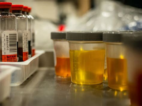 Urine Specimen Analysis