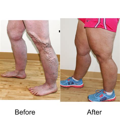 Description of Varicose Veins Treatment