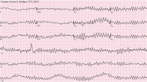 Ventricular Fibrillation EKG