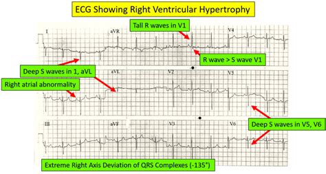 Ventricular hypertrophy EKG interpretation