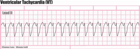 Ventricular Tachycardia EKG