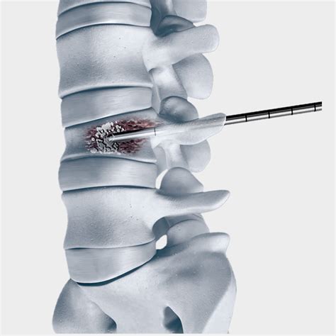 Vertebroplasty