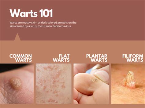 Wart Causes and Symptoms