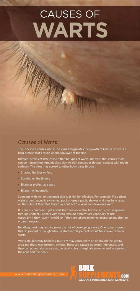 Wart Causes