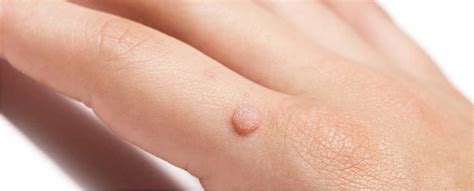 Wart Prevention Strategies