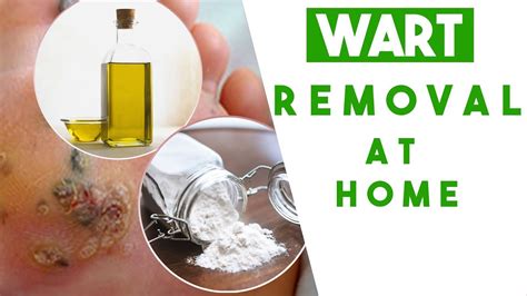 Wart Removal at Home