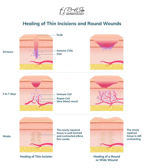 Wart removal methods