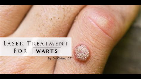 Wart removal procedures