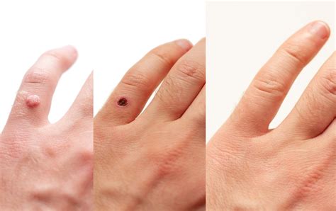 Wart removal techniques