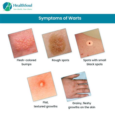 Wart Symptoms