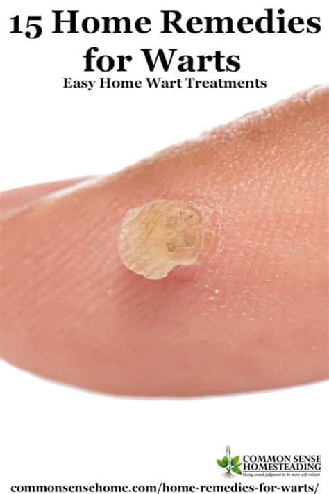 Wart Treatment Methods