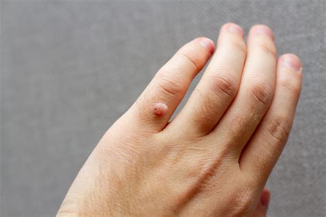 Warts on fingers