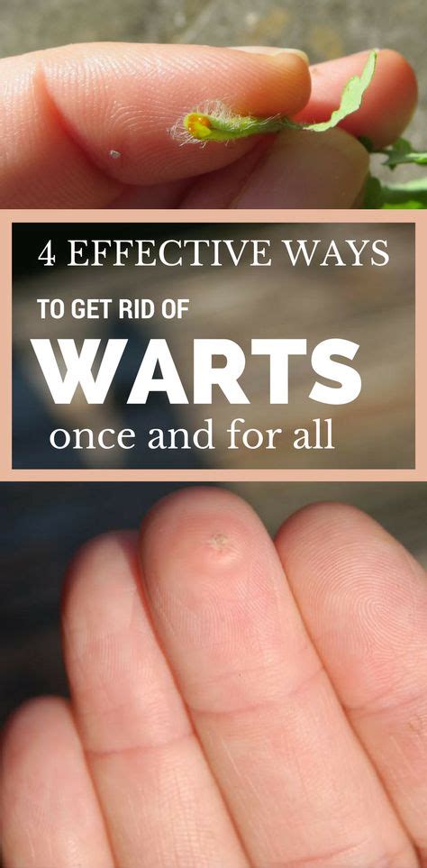 Ways to remove warts