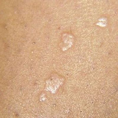 Ways Warts Spread