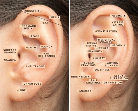 Weight Loss Ear Seed Placement Chart