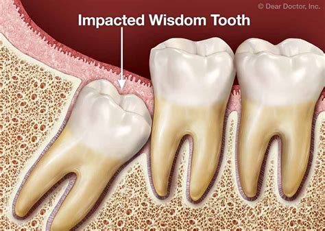 Description of Wisdom Teeth Extraction