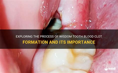 Wisdom tooth clot formation process