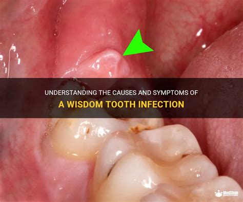 Wisdom tooth infection symptoms