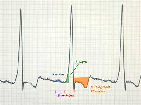 Wolff-Parkinson-White Syndrome EKG