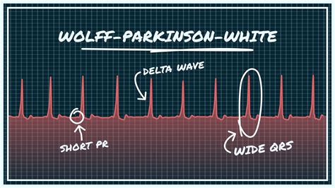 Wolff-Parkinson-White Syndrome EKG