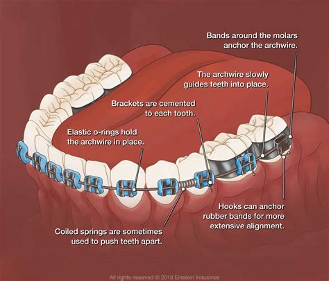 Working Mechanism of Bledsoe Braces