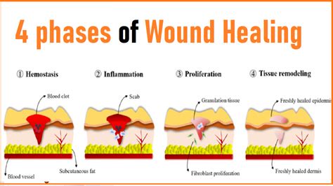 Wound Healing