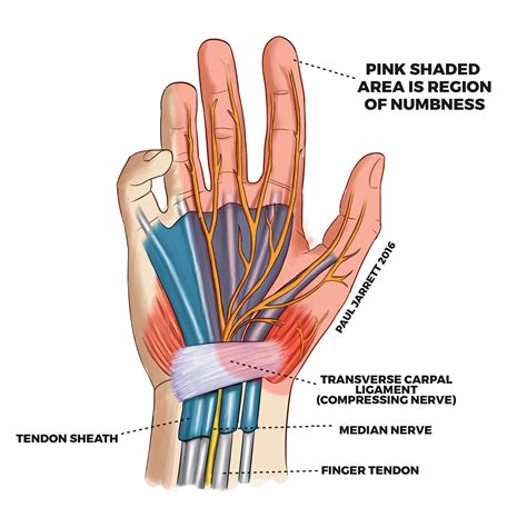 Wrist carpal tunnel