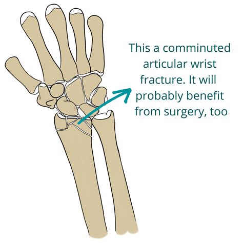 Wrist fractures