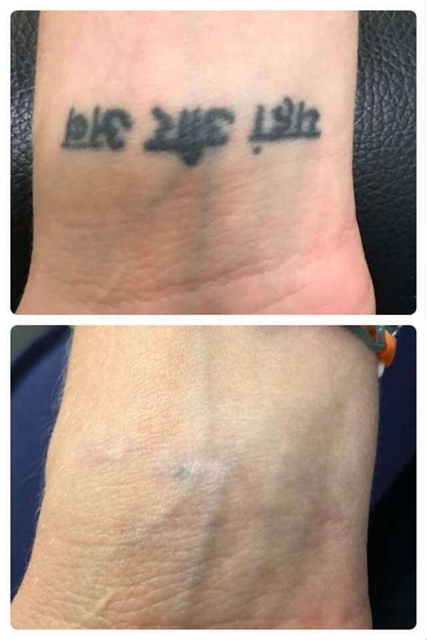 Wrist tattoo removal options and cost