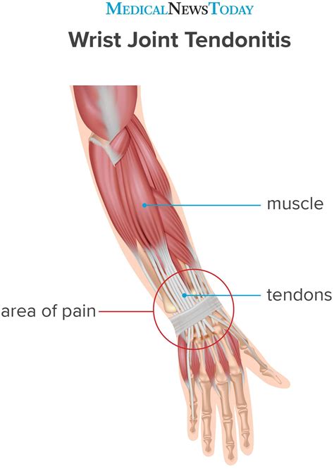 Wrist tendonitis