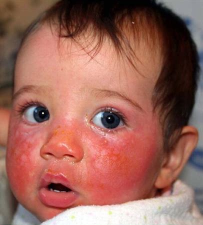 Xeroderma, a condition characterized by dry skin